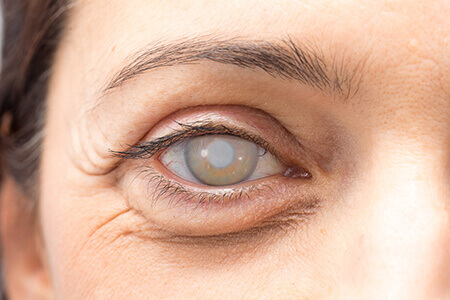 woman's cataract